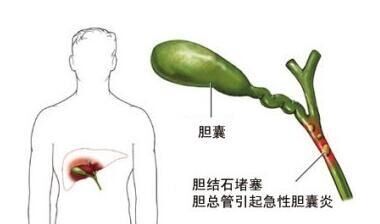 胆囊结石最新治疗技术概览